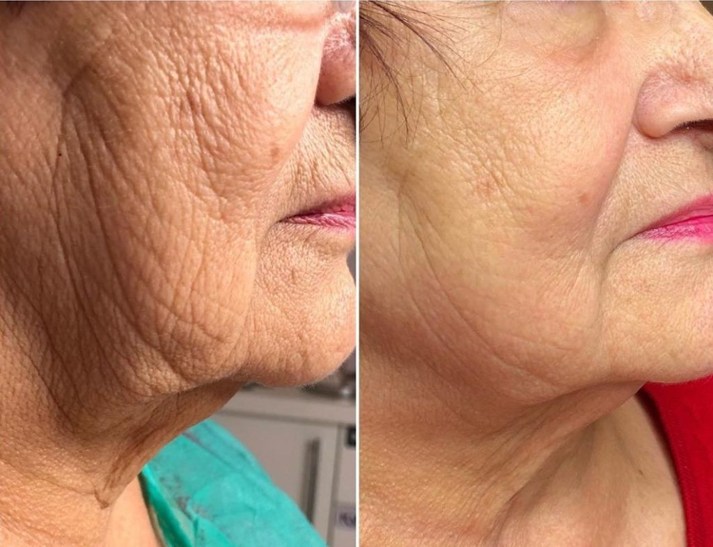 how-to-remove-wrinkles-from-face-झुर्रियों-को-कैसे-दूर wrinkes