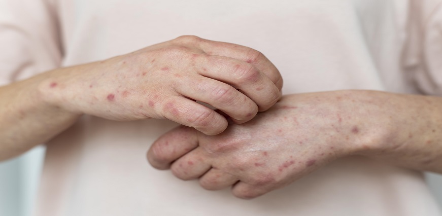 त्वचा एलर्जी के लिए घरेलू उपचार